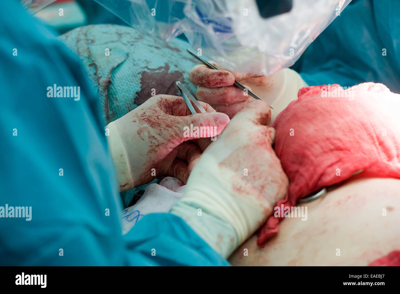 Due chirurghi lavorando precisamente insieme durante un'operazione in un ospedale Foto Stock