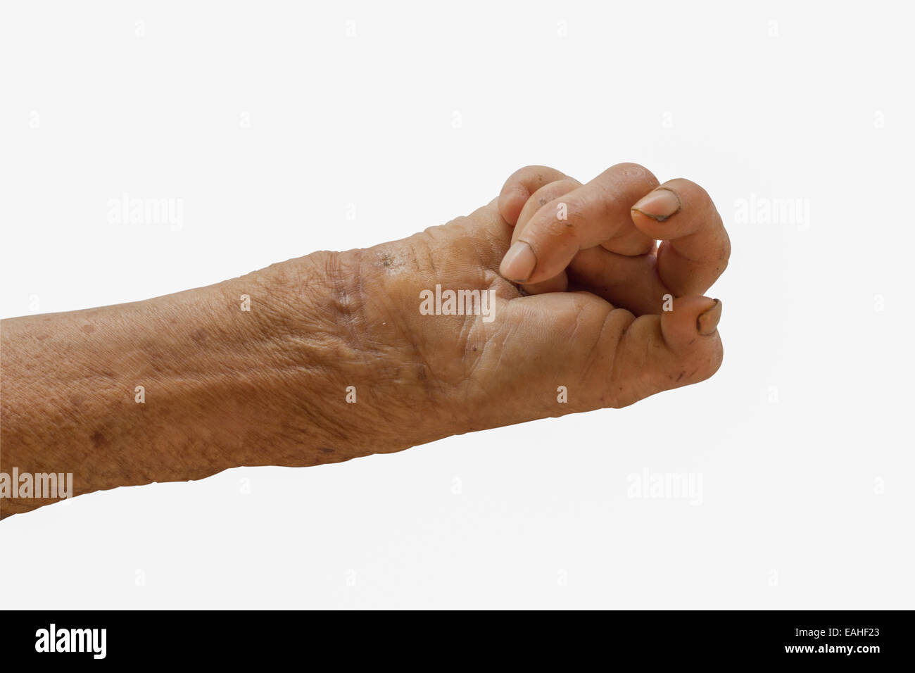 La mano destra di una lebbra isolati su sfondo bianco Foto Stock