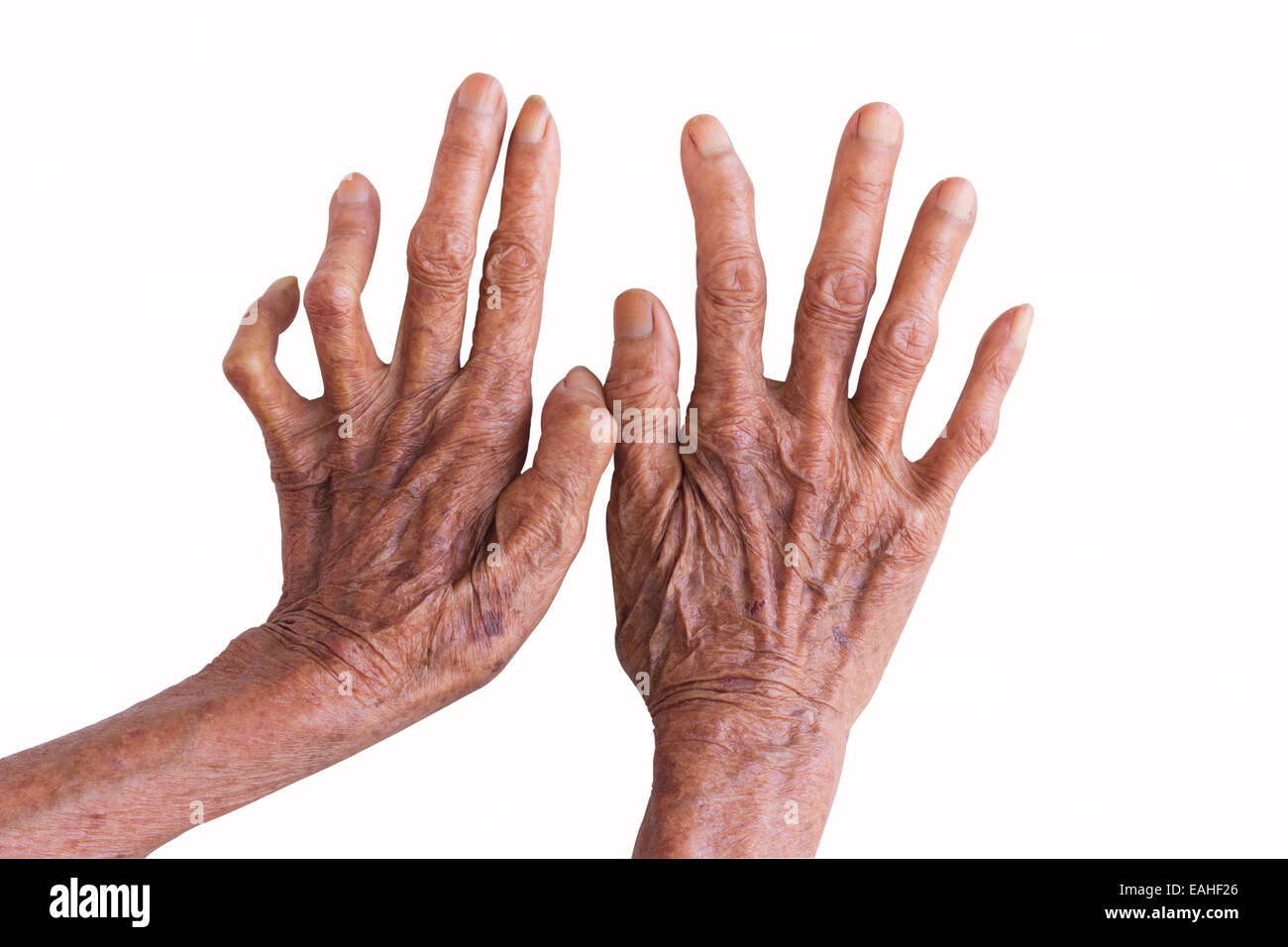 Le mani di una lebbra isolati su sfondo bianco Foto Stock