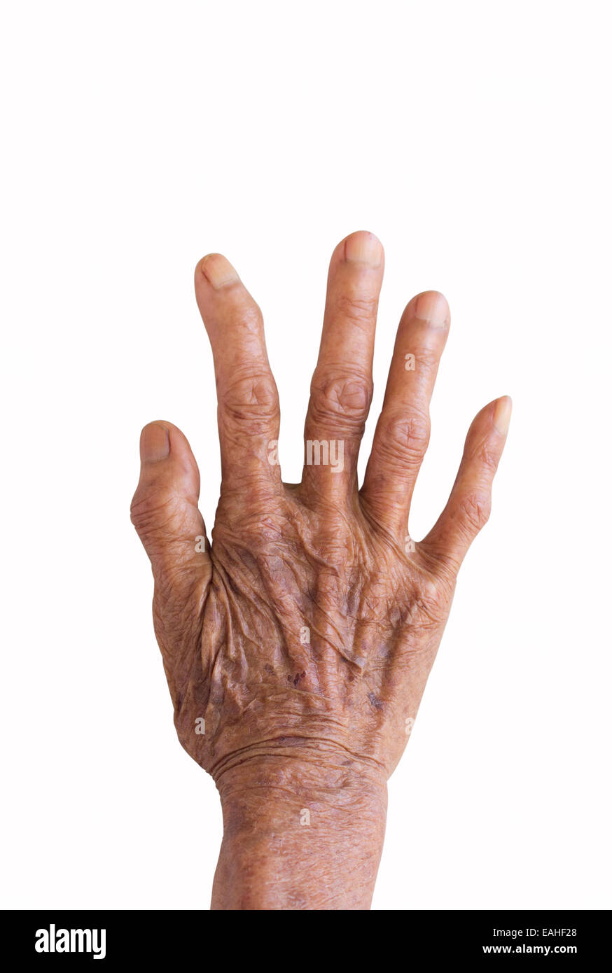 La mano destra di una lebbra isolati su sfondo bianco Foto Stock