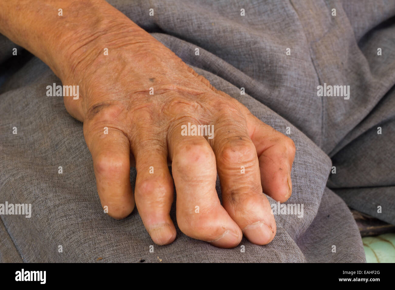 Lato sinistro della lebbra. Foto Stock