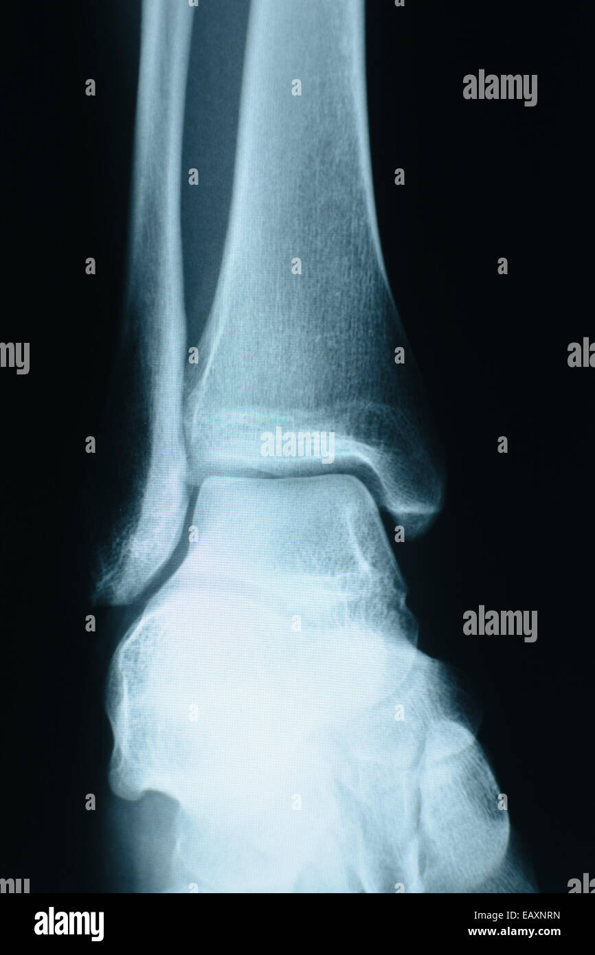 Tallone femminile xray, alta risoluzione tiro effettuato in un ospedale. Foto Stock