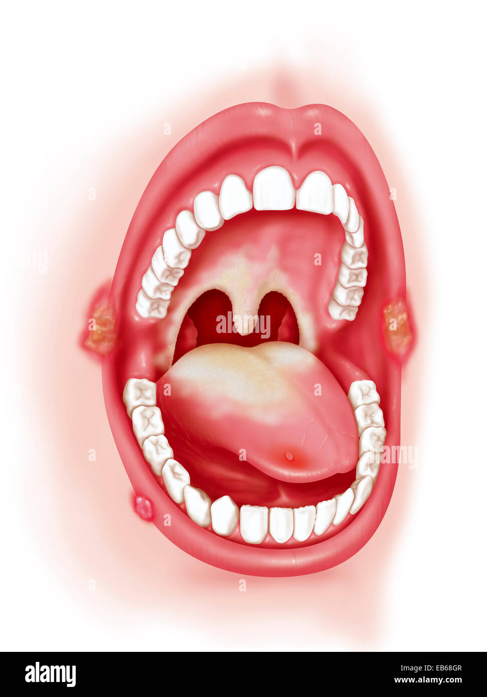 Patologia orale, illustrazione Foto Stock