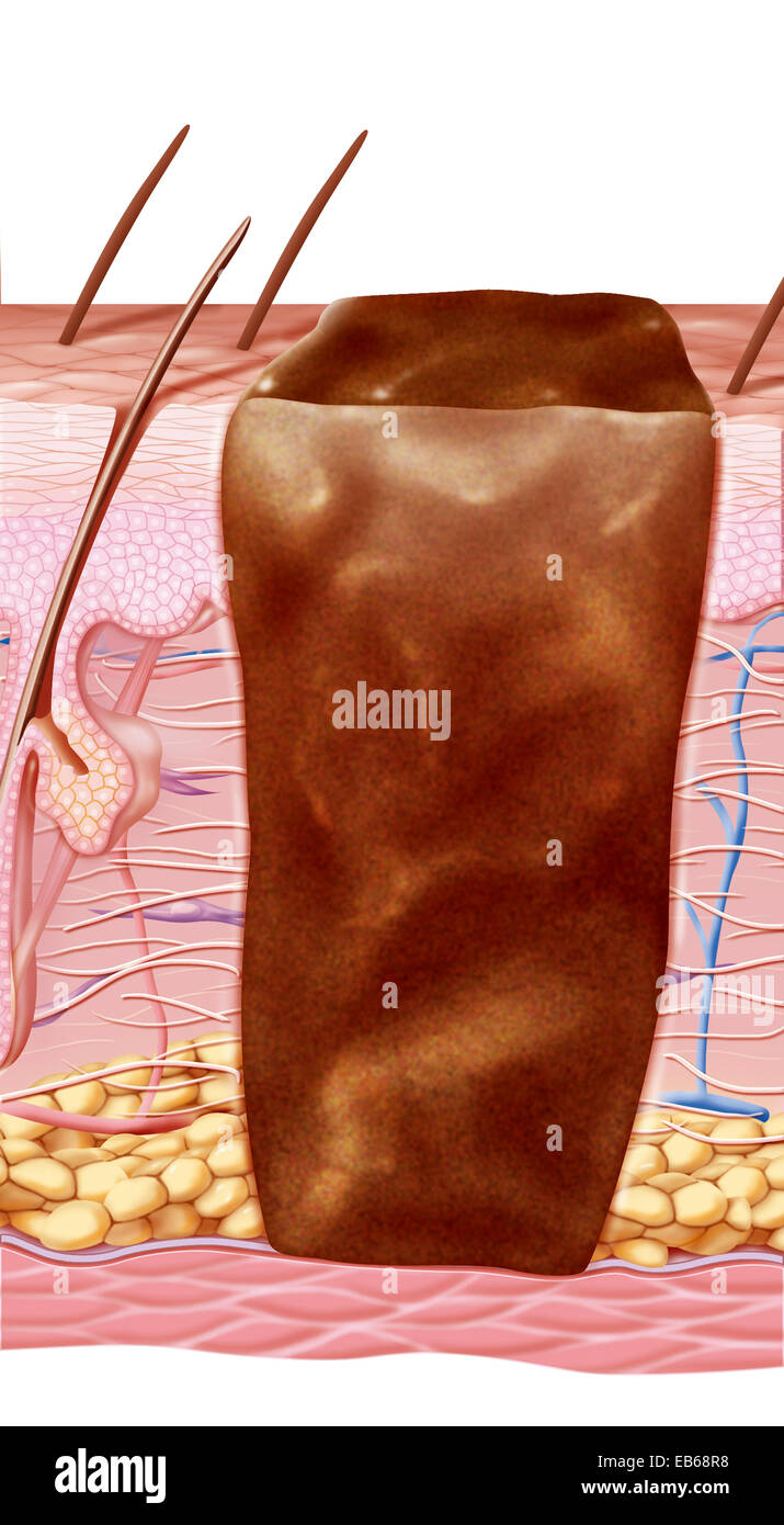 La guarigione della ferita, illustrazione Foto Stock