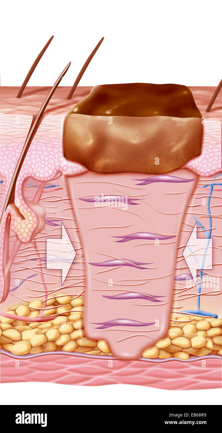 La guarigione della ferita, illustrazione Foto Stock