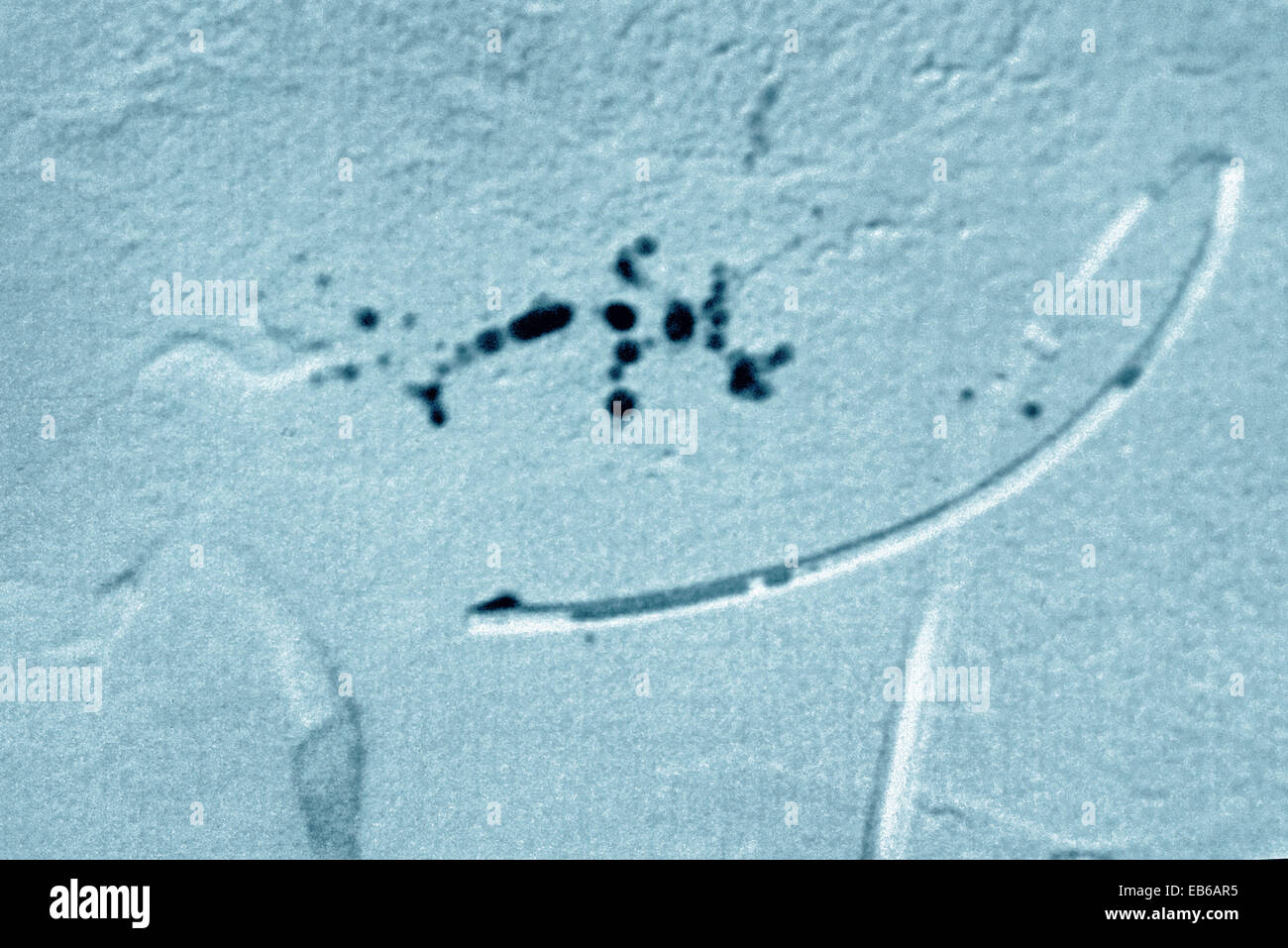 CHEMOEMBOLIZATION Foto Stock