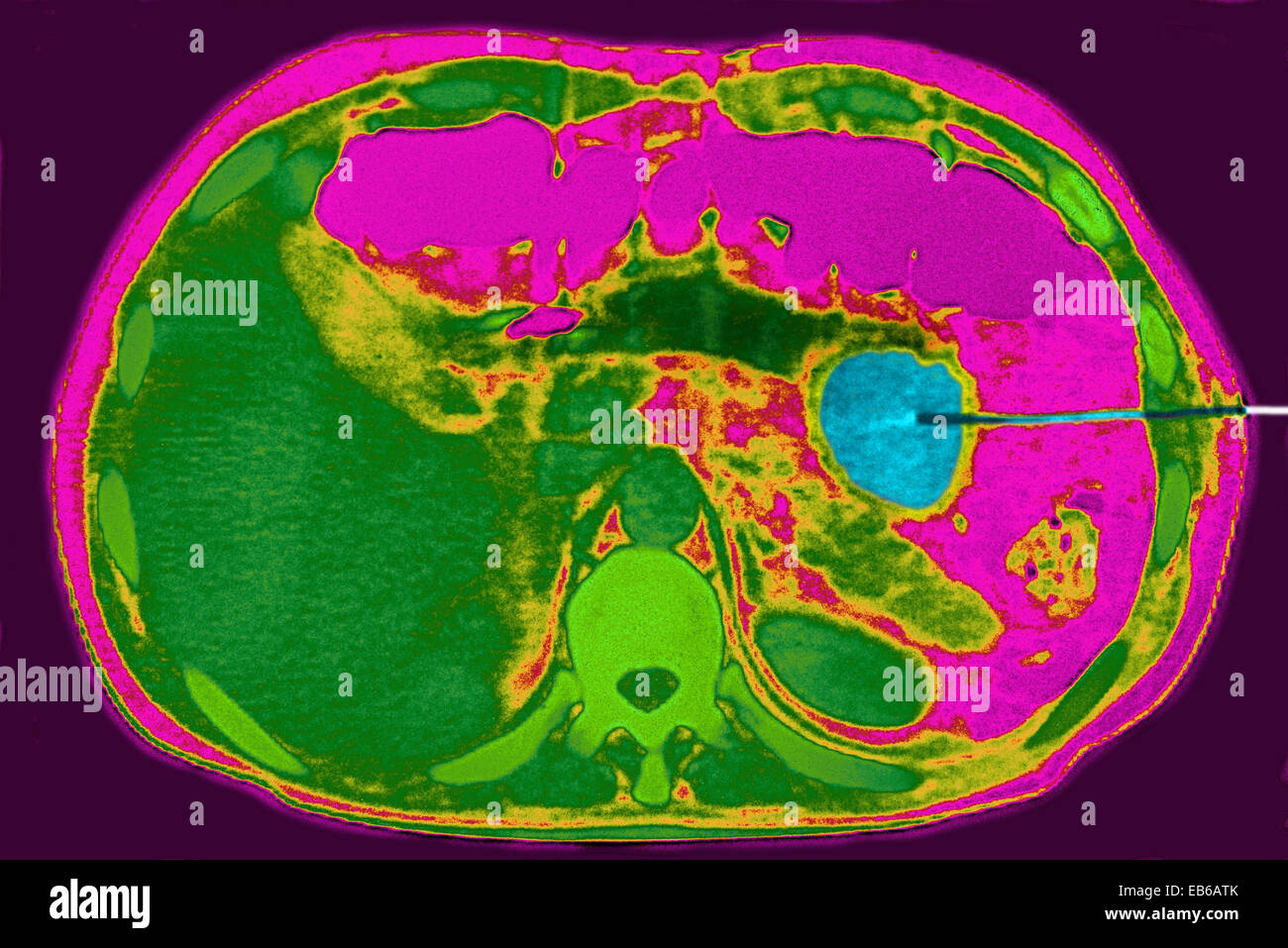 Cisti pancreatica, la foratura Foto Stock