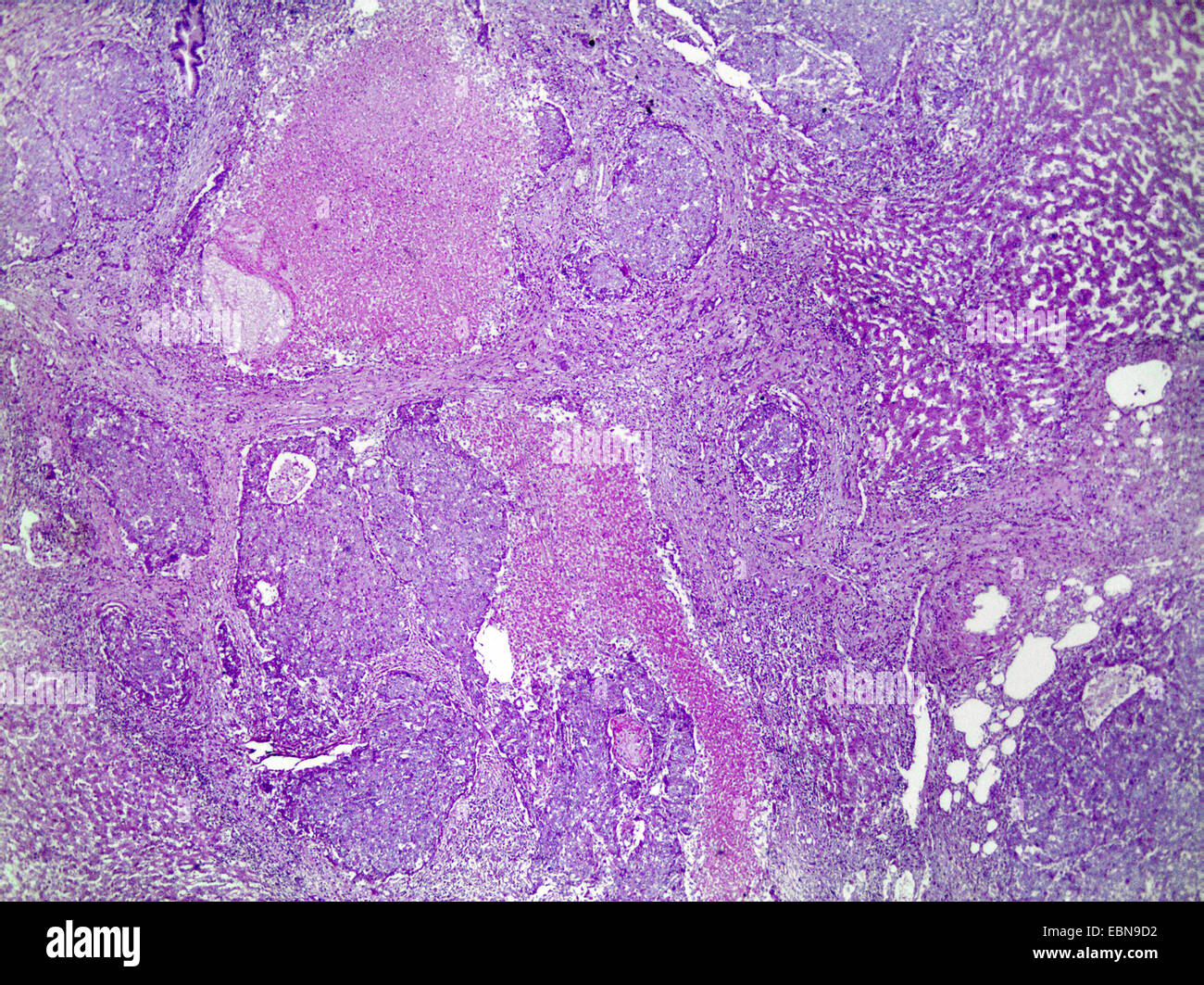 Cancro epatico, sezione microscopico, 40 x Foto Stock