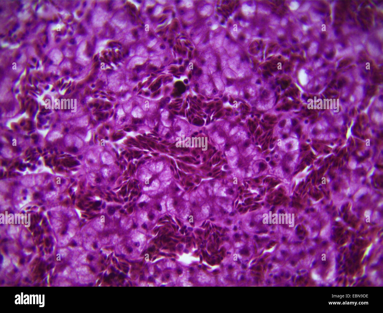 Secondary cancro epatico, sezione microscopico, 400 x Foto Stock