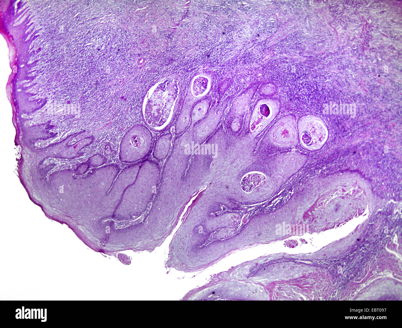 Squamoso cancro dermica, 40 x Foto Stock