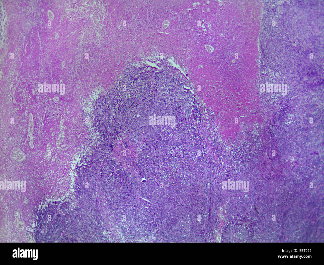 Dermal Cancer, 40 x Foto Stock