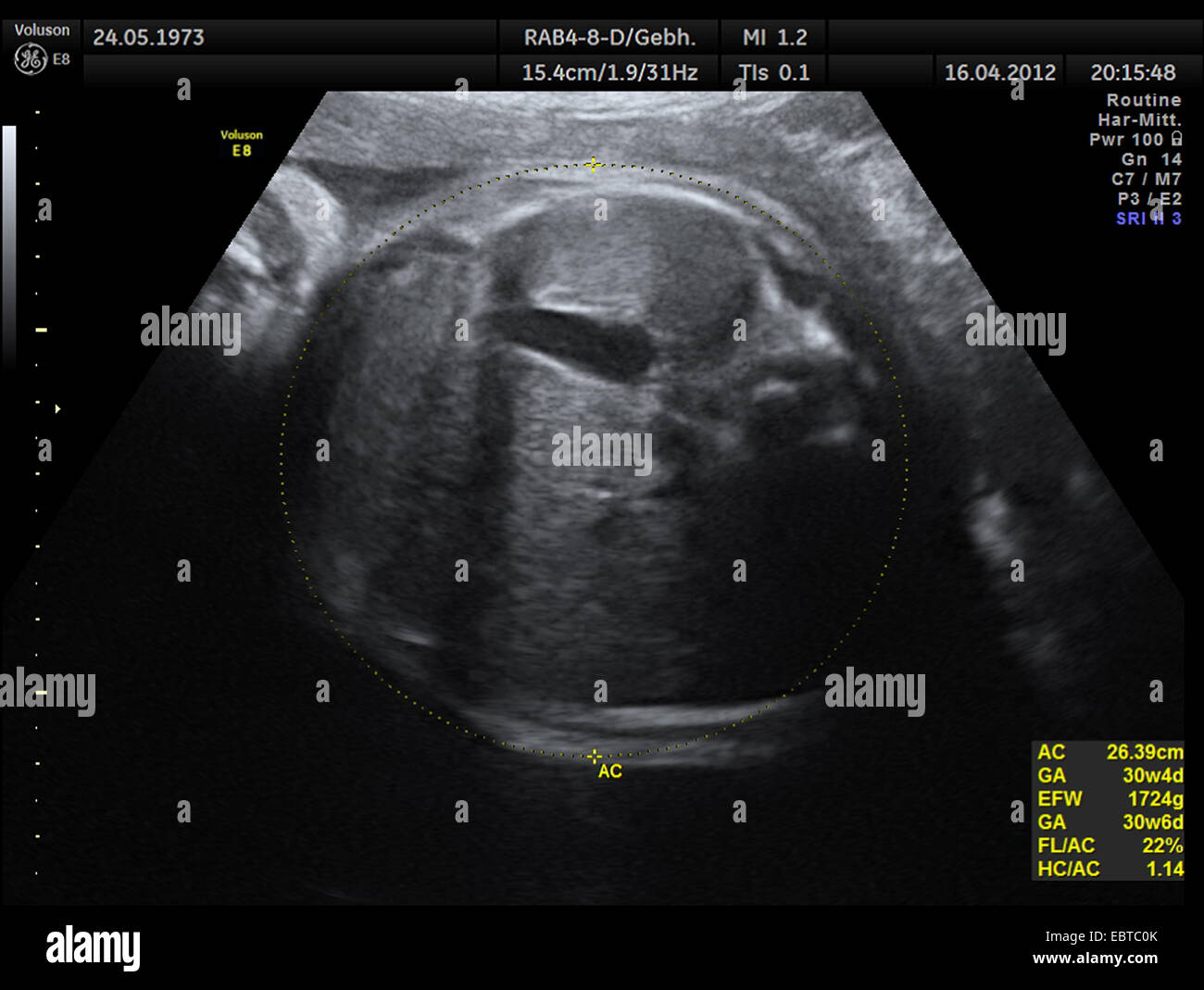 Sonogram di un embrione nel grembo Foto Stock