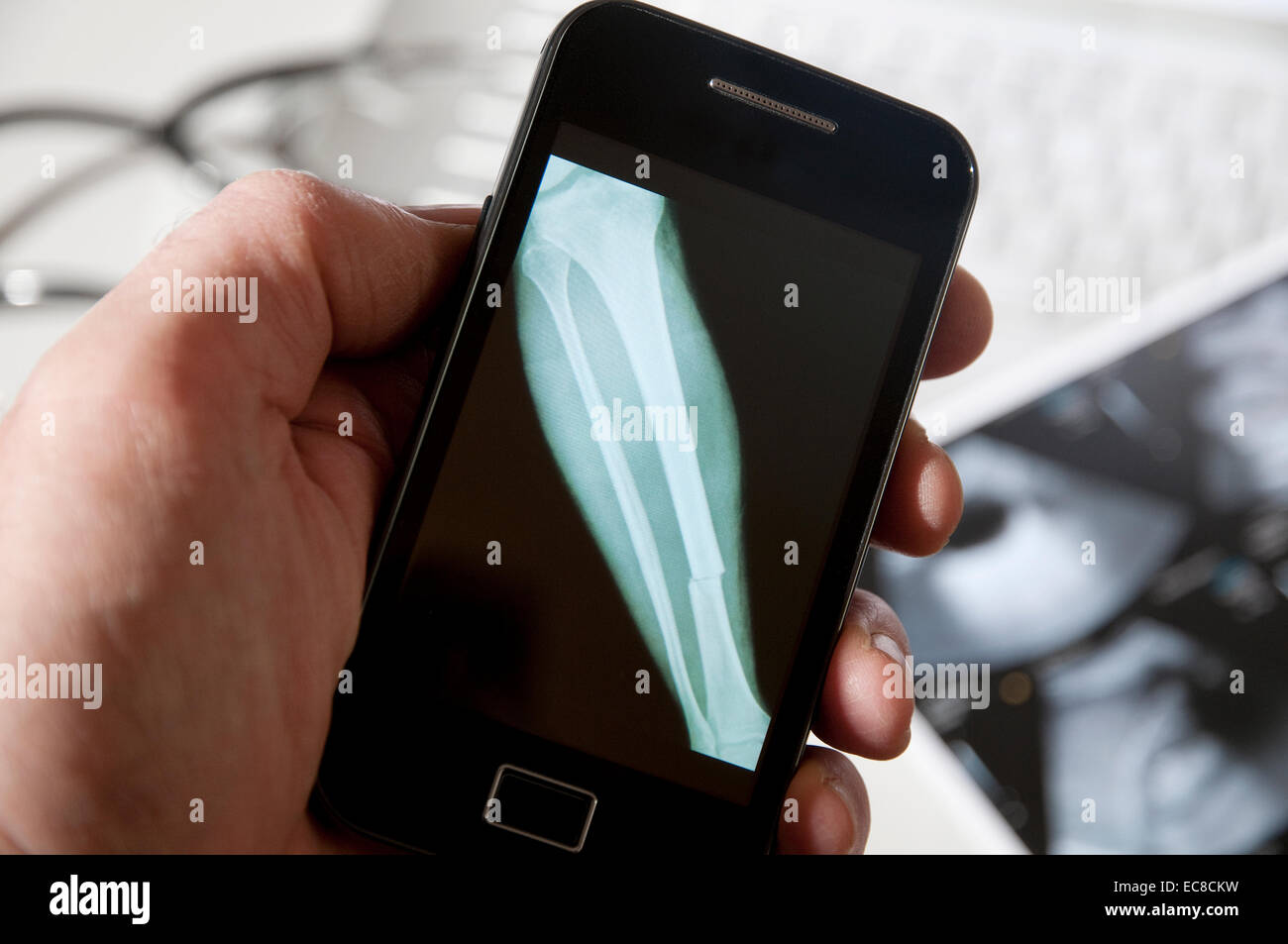 Raggi X della gamba rotta osso sulla schermata dello smartphone Foto Stock