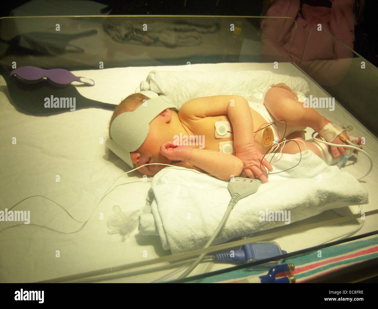 Un nuovo bambino in ospedale sotto le luci di una macchina per aiutare la funzione del fegato come ha bisogno. Foto Stock