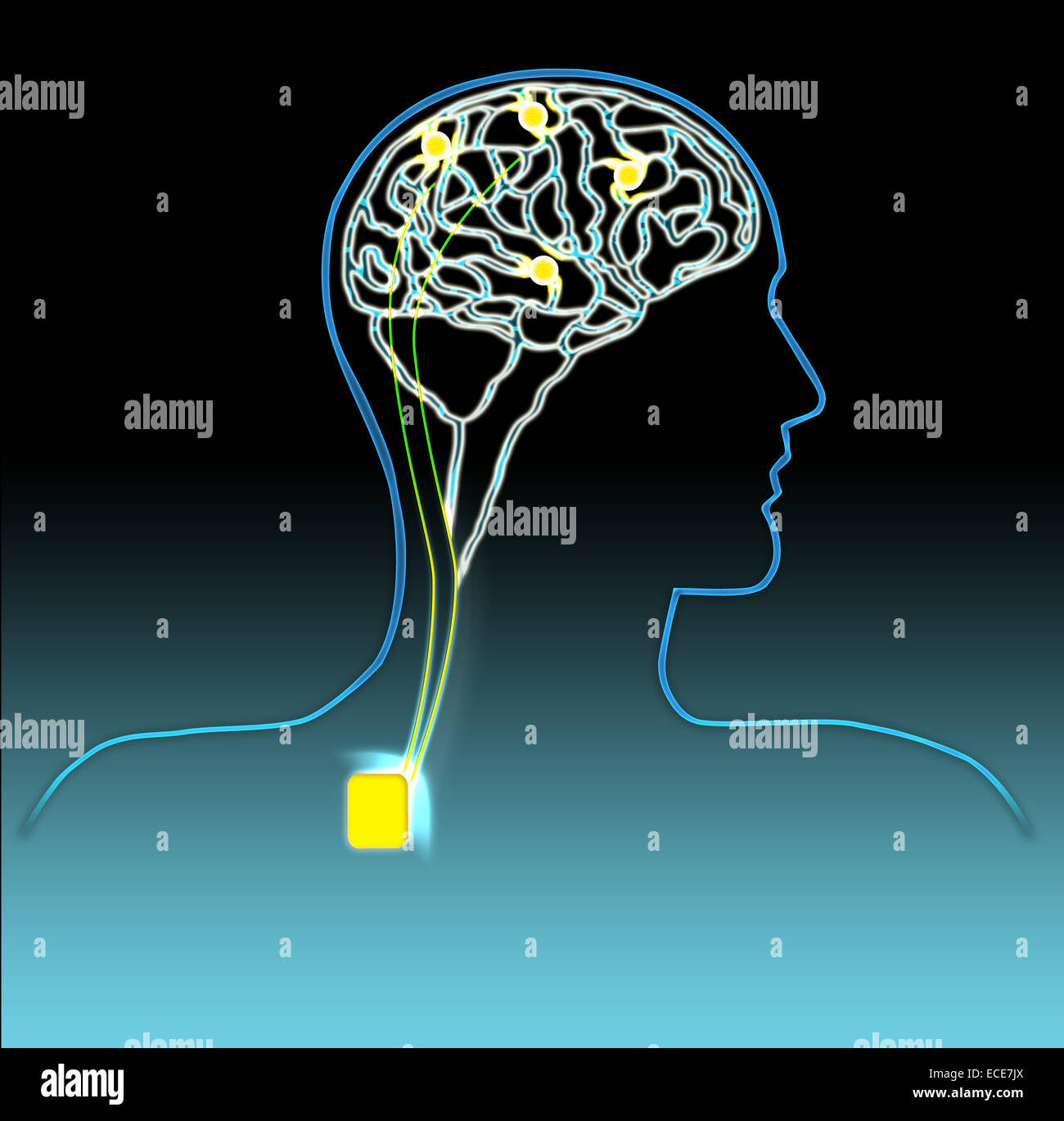 Concetto di impianto neurale di stimolazione cerebrale profonda (DBS) e circuito cerebrale: Futuro delle neurotecnologie Foto Stock