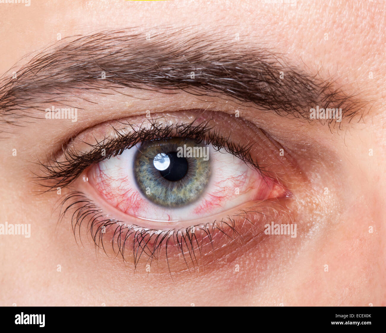 Close up irritato rosso sangue occhio. Foto Stock