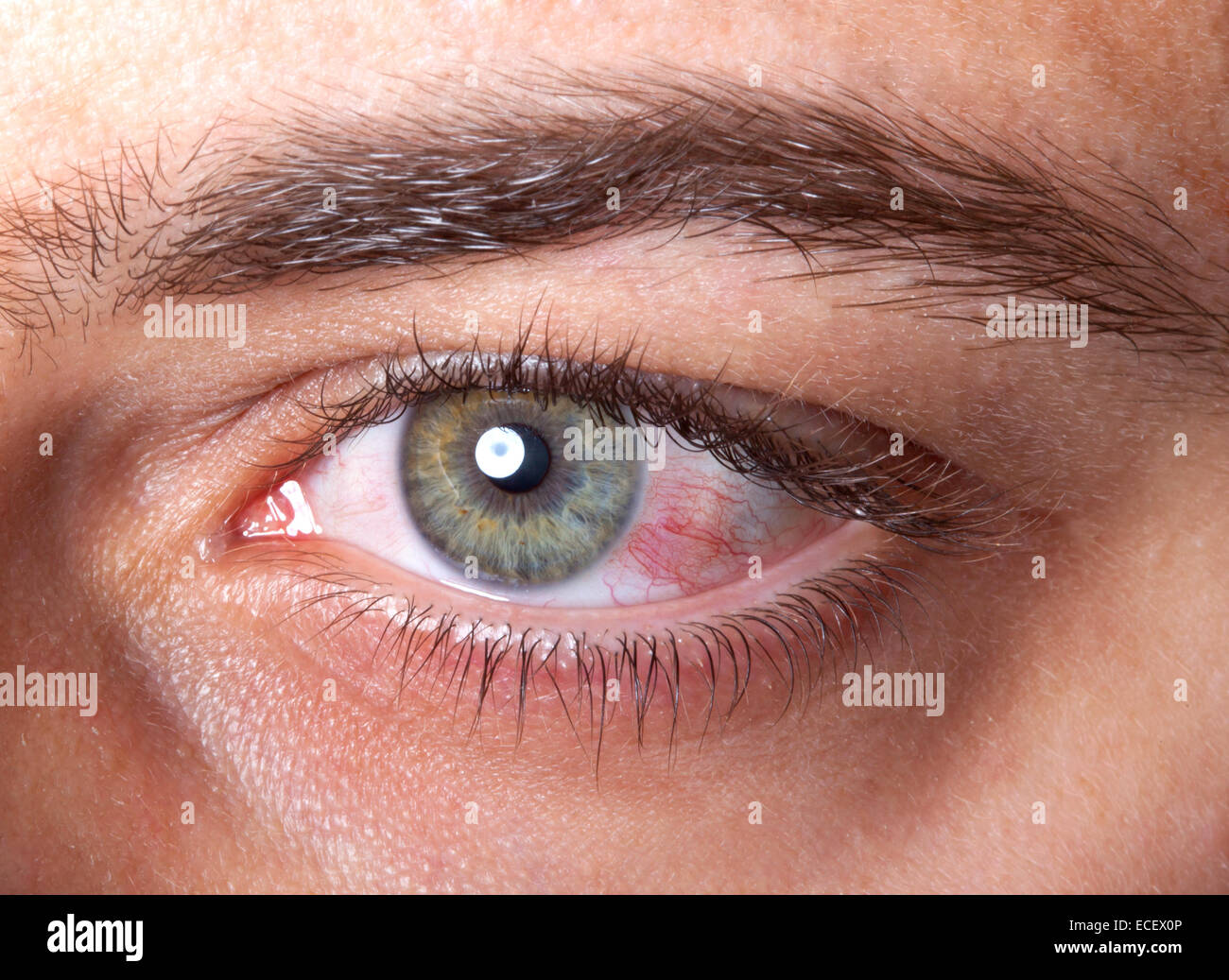 Close up irritato rosso sangue occhio. Foto Stock