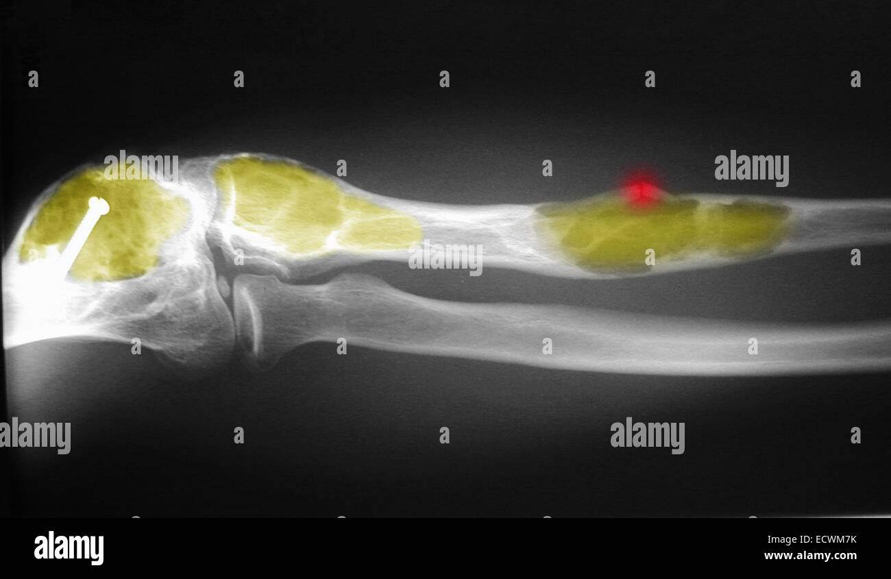 X-ray mostra displasia fibrosa dell'ulna e omero. Foto Stock