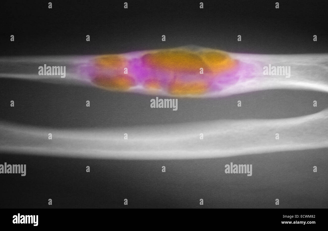 X-ray mostra displasia fibrosa dell'ulna e omero. Foto Stock