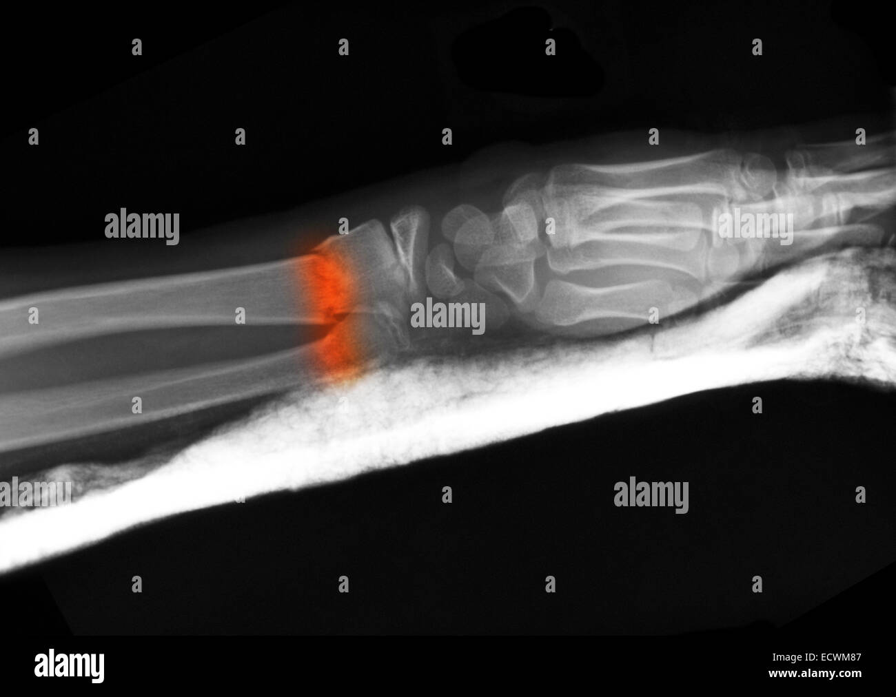 X-ray dell'avambraccio che mostra una frattura. Foto Stock