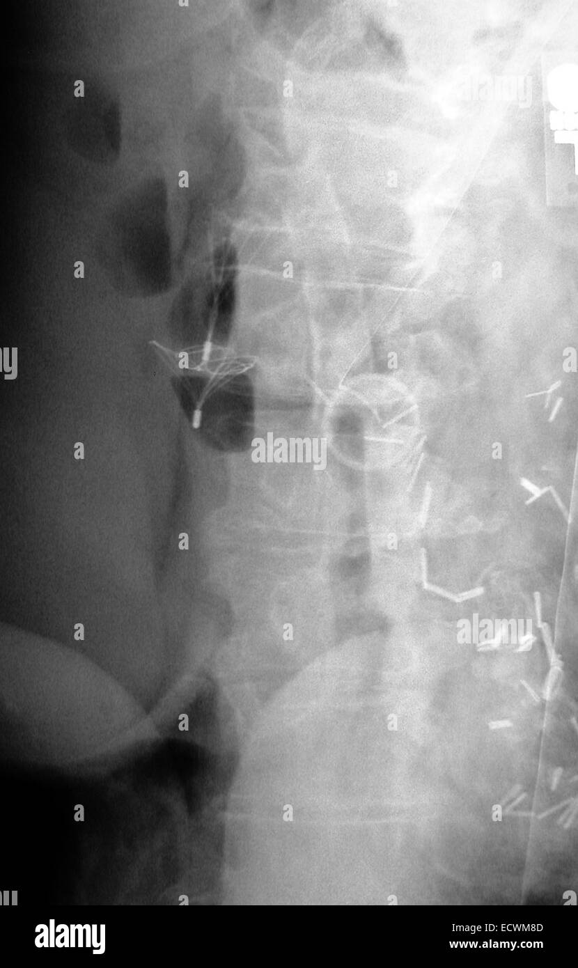 Addome raggi x che mostra una vena cava di coagulo di sangue del filtro. Foto Stock