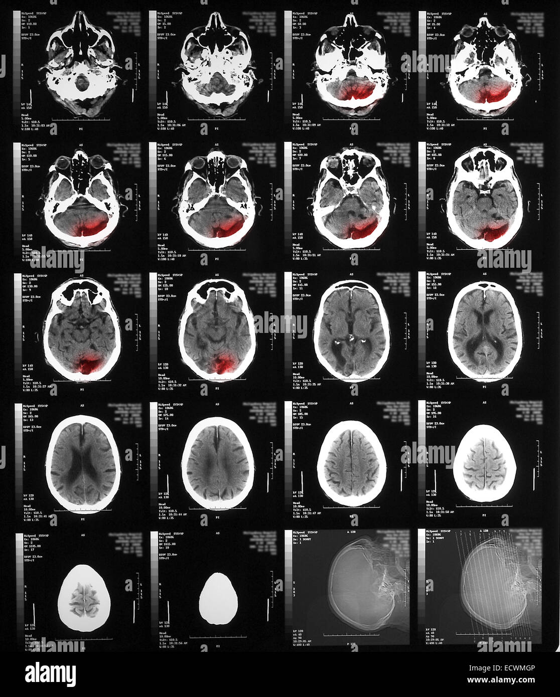 CT scan mostra atrofia dei due emisferi cerebrali Foto Stock