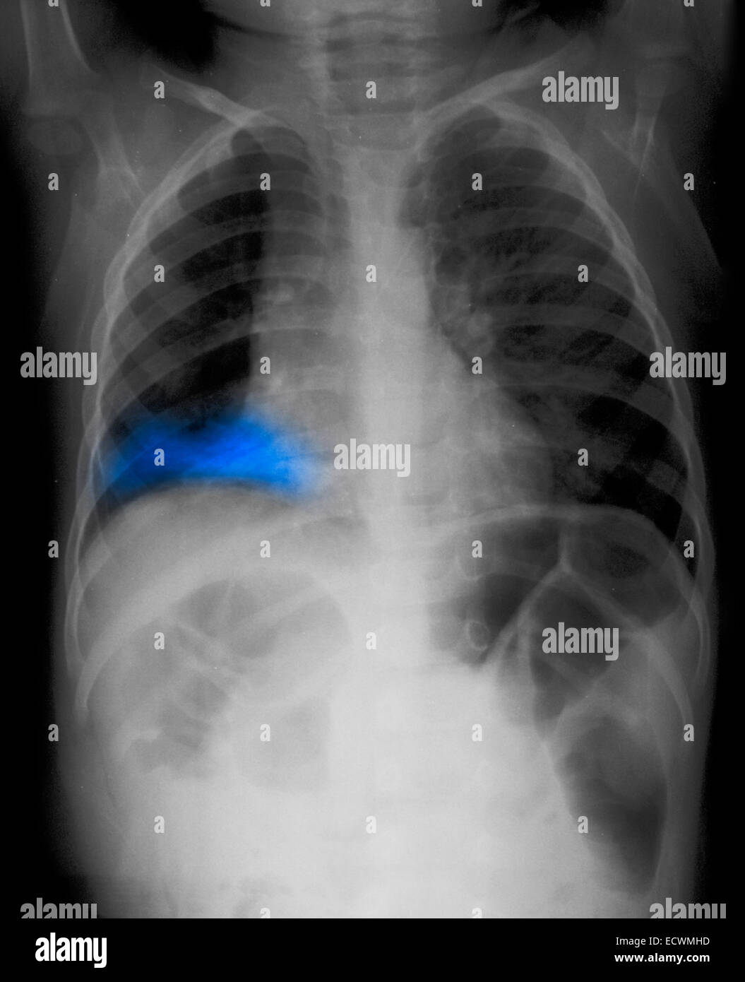 I raggi x al torace che mostra un diritto lobo inferiore la polmonite. Foto Stock