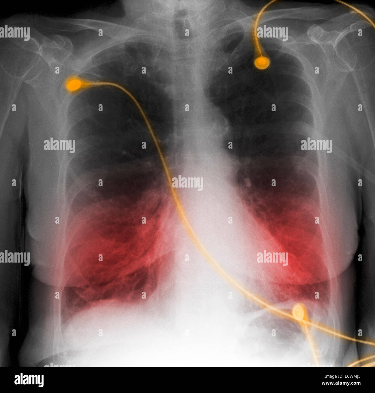 CXR mostra COPD, malattia polmonare ostruttiva cronica. Foto Stock