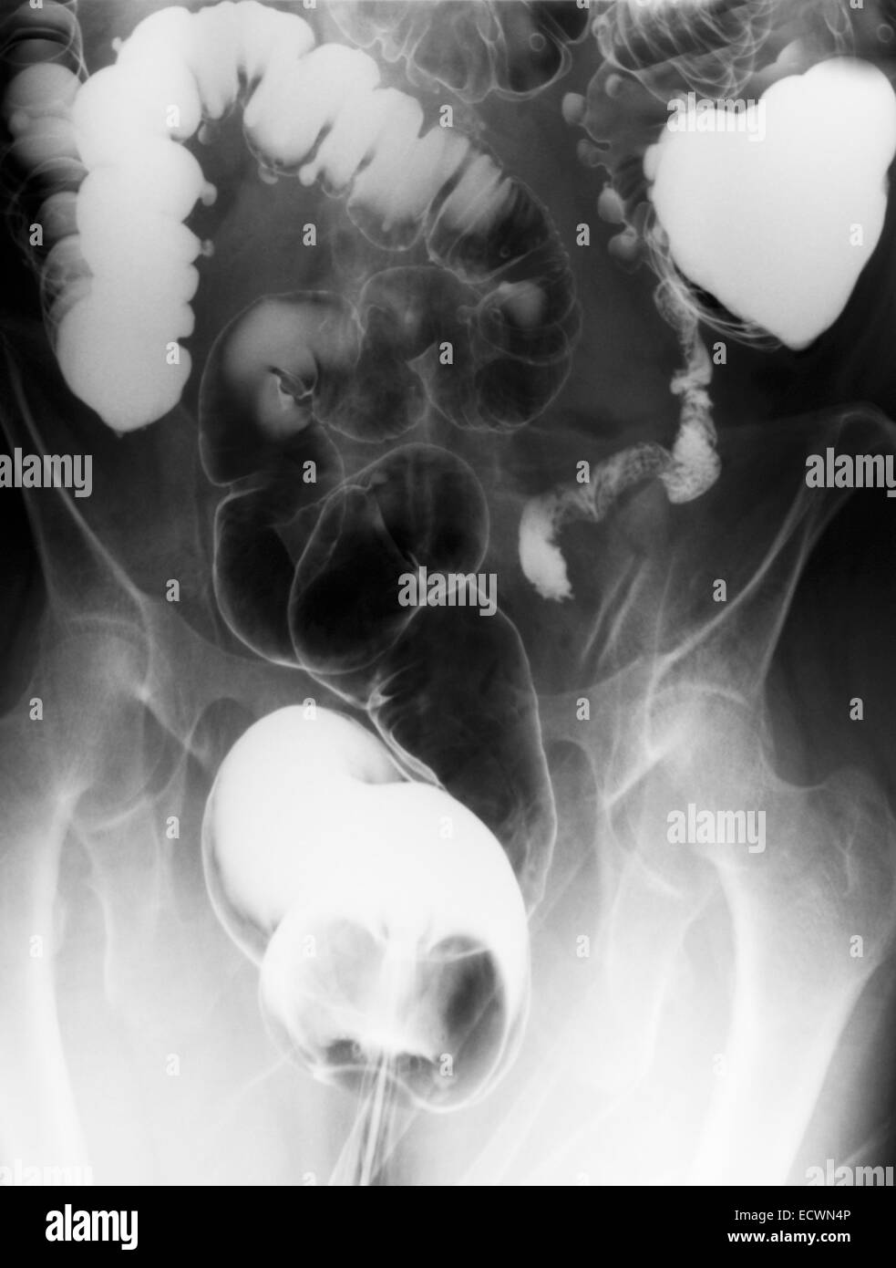 Addome raggi x che mostra la diverticolosi del colon. Foto Stock