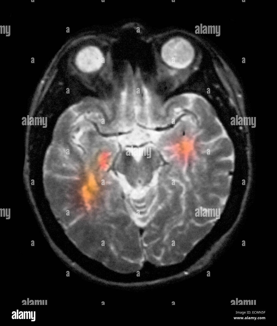 Risonanza magnetica cerebrale che mostra la sclerosi multipla. Femmina di 36 anni Foto Stock