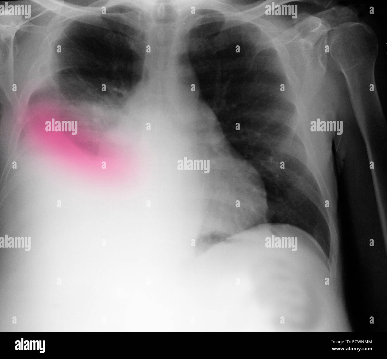 I raggi x al torace che mostra la cirrosi e un versamento pleurico. Foto Stock