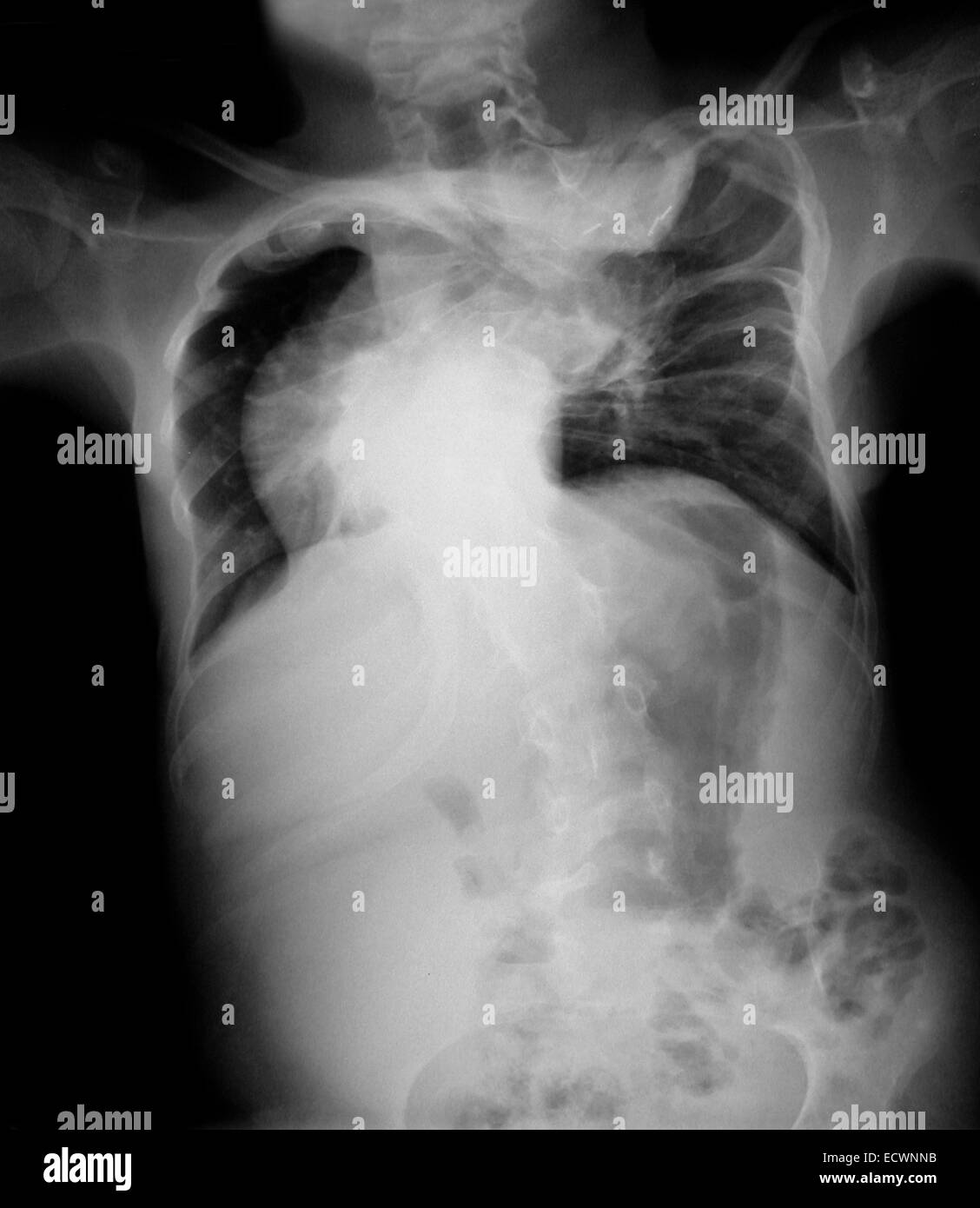 I raggi x al torace di un ragazzo di 15 anni con gravi scolosis. Foto Stock