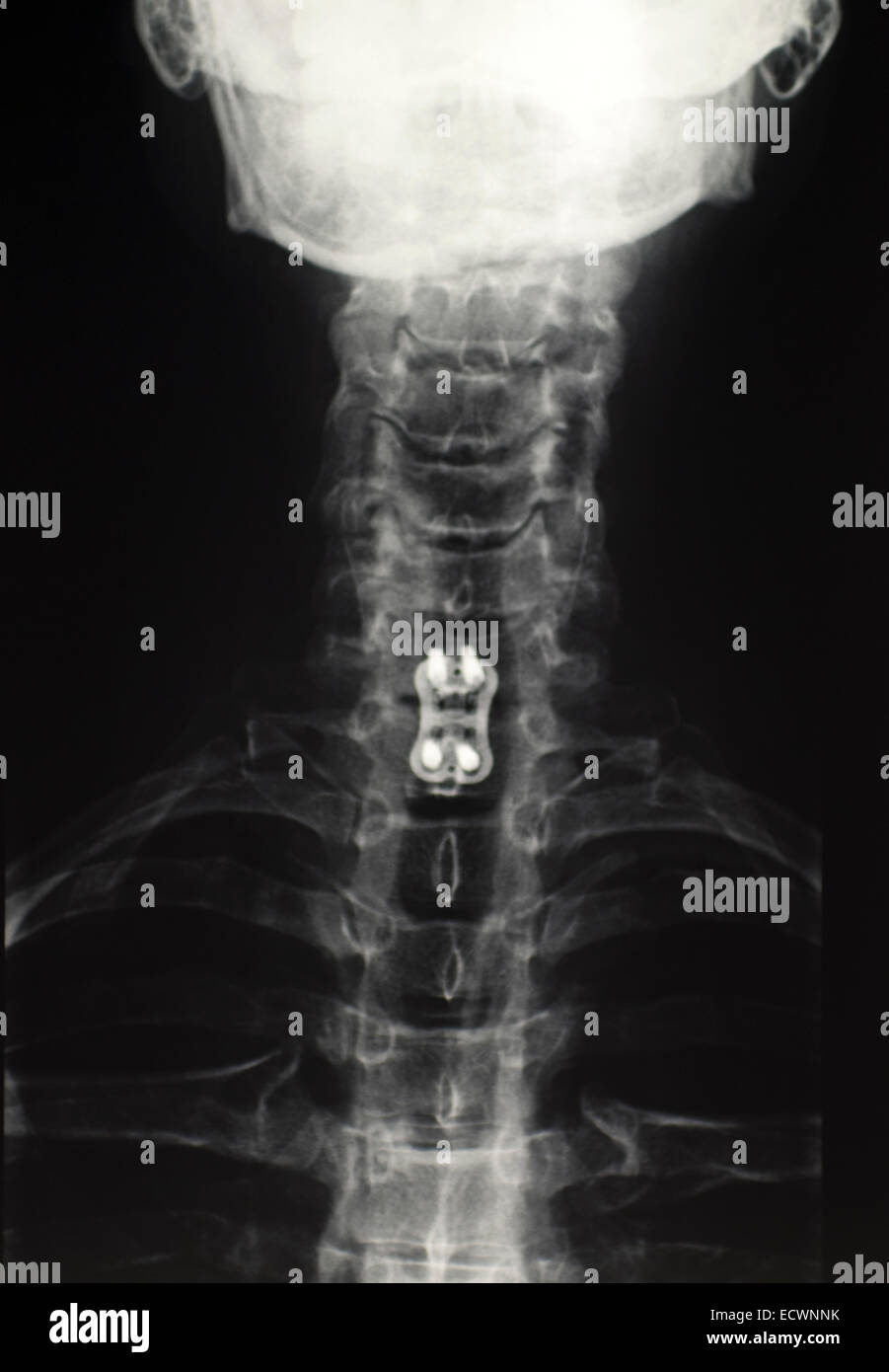Collo cervicale raggi x che mostra la fusione spinale. Foto Stock