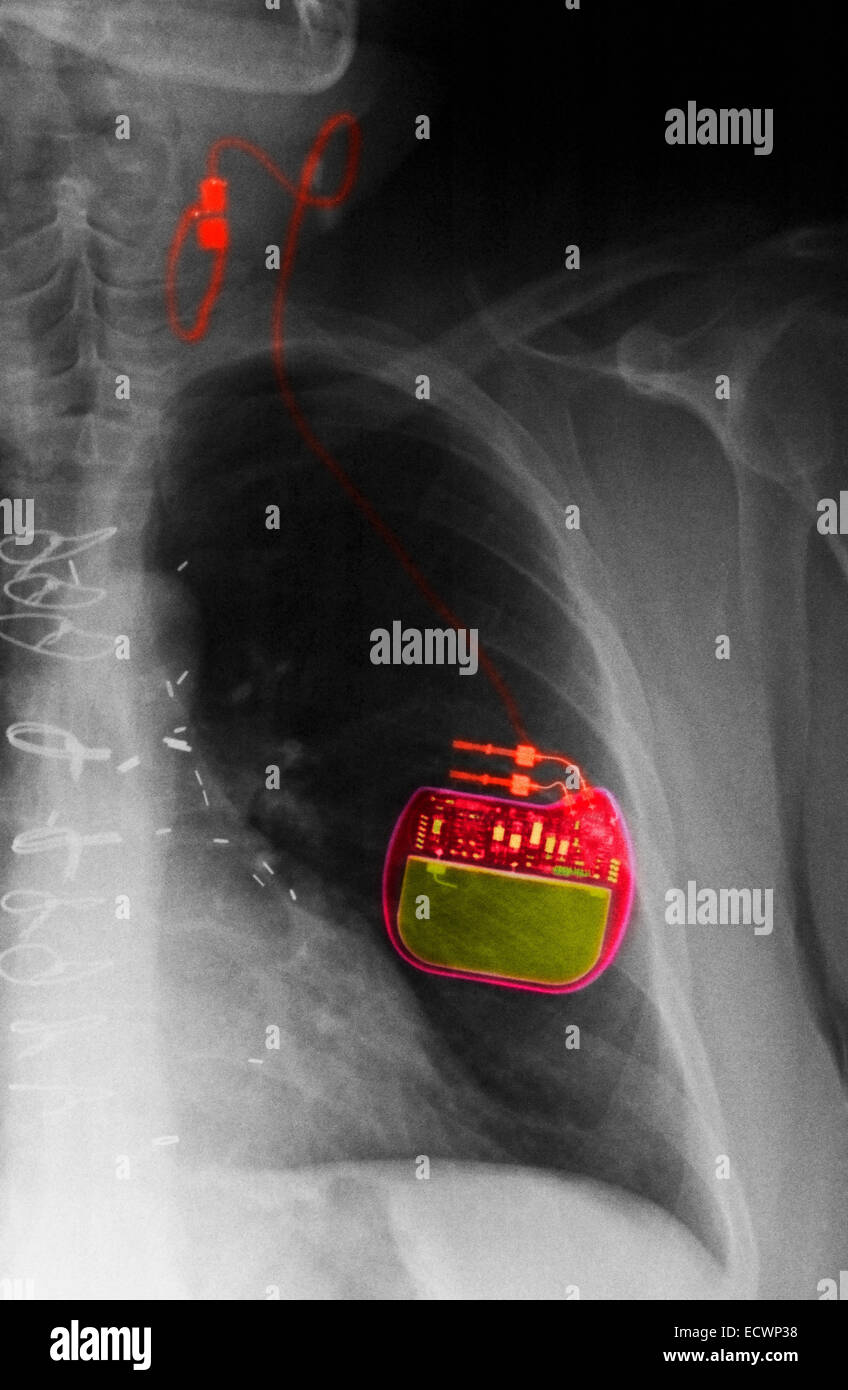 I raggi x al torace che mostra un nervo vago stimolatore per l'epilessia. Foto Stock