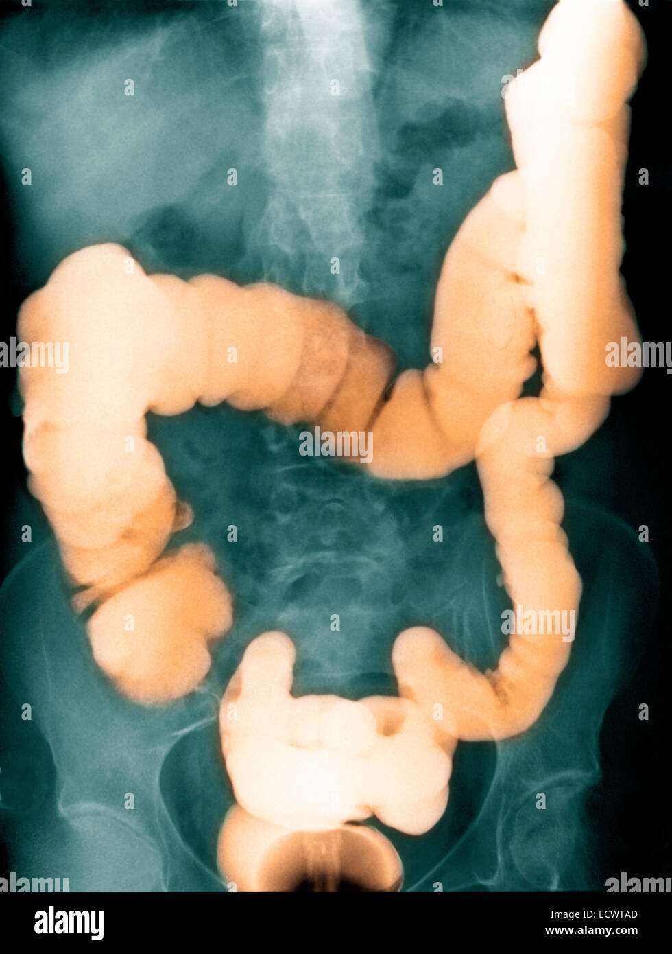 Addome x-ray mostra un contrasto di bario studio del colon. Foto Stock