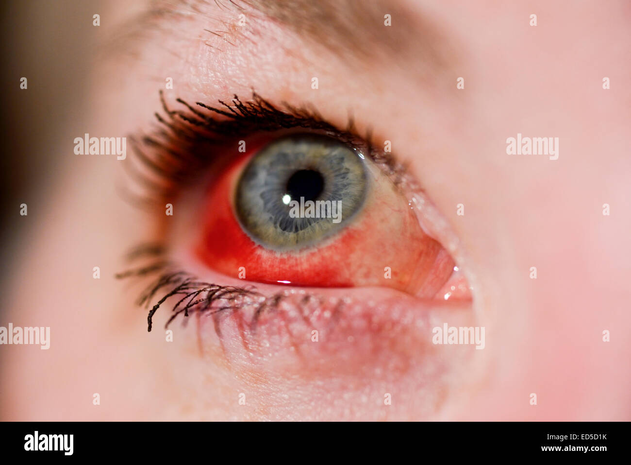 Womans occhio con rotture di vaso sanguigno (emorragia subcongiuntivale) Foto Stock