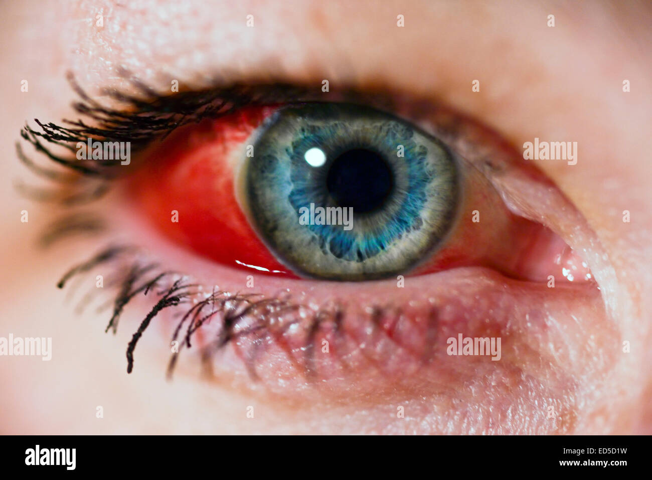 Donna di occhio con rotture di vaso sanguigno (emorragia subcongiuntivale) Foto Stock