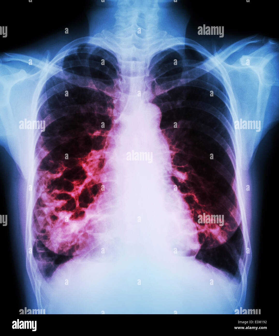 "Broncoectasia' X-ray petto show : polmonari multiple bolla e cisti a causa di infezione cronica Foto Stock