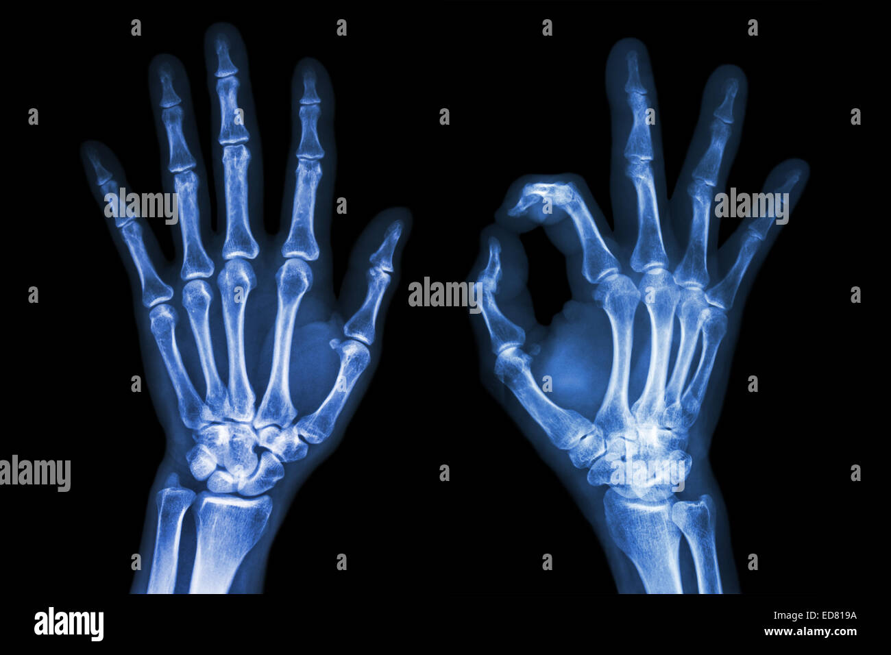 X-ray entrambe le mani con segno OK Foto Stock