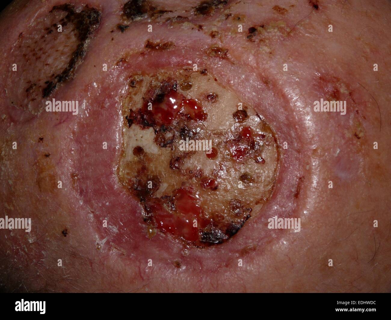 A Squamous Cell Carcinoma del cuoio capelluto Foto Stock