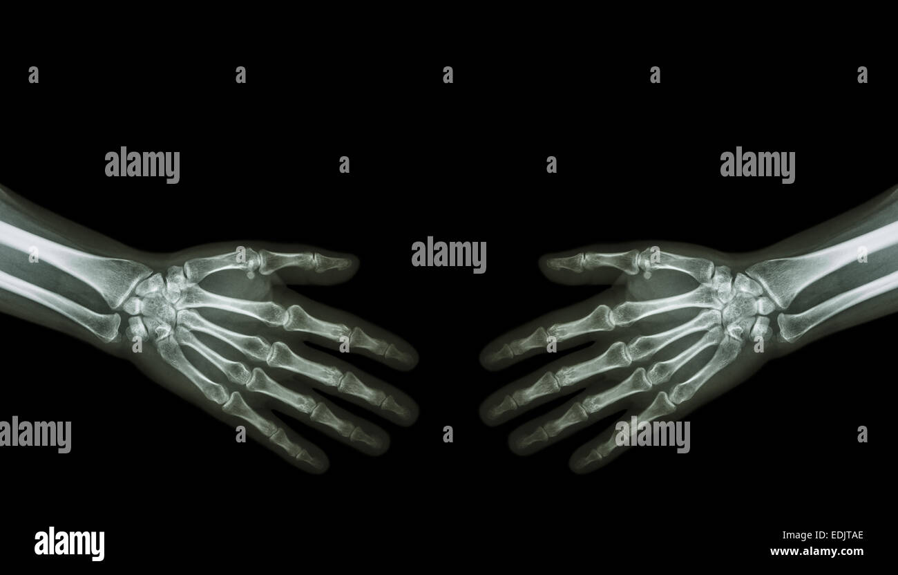 Agitare le mani . X-ray normale mani umane ( area vuota sul lato superiore ) Foto Stock