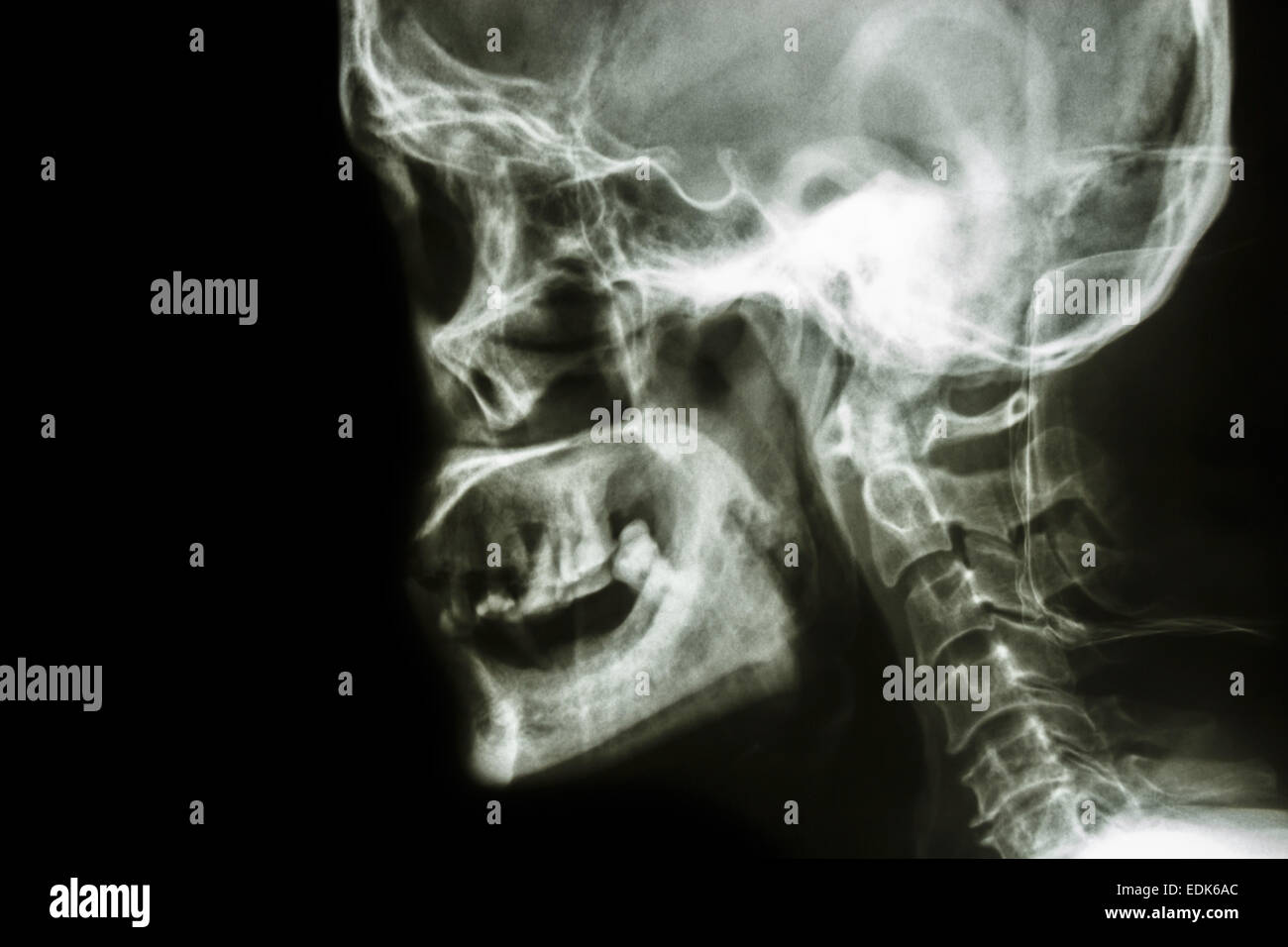 Film x-ray laterale del cranio : mostra umano normale del cranio e la zona vuota a sinistra Foto Stock