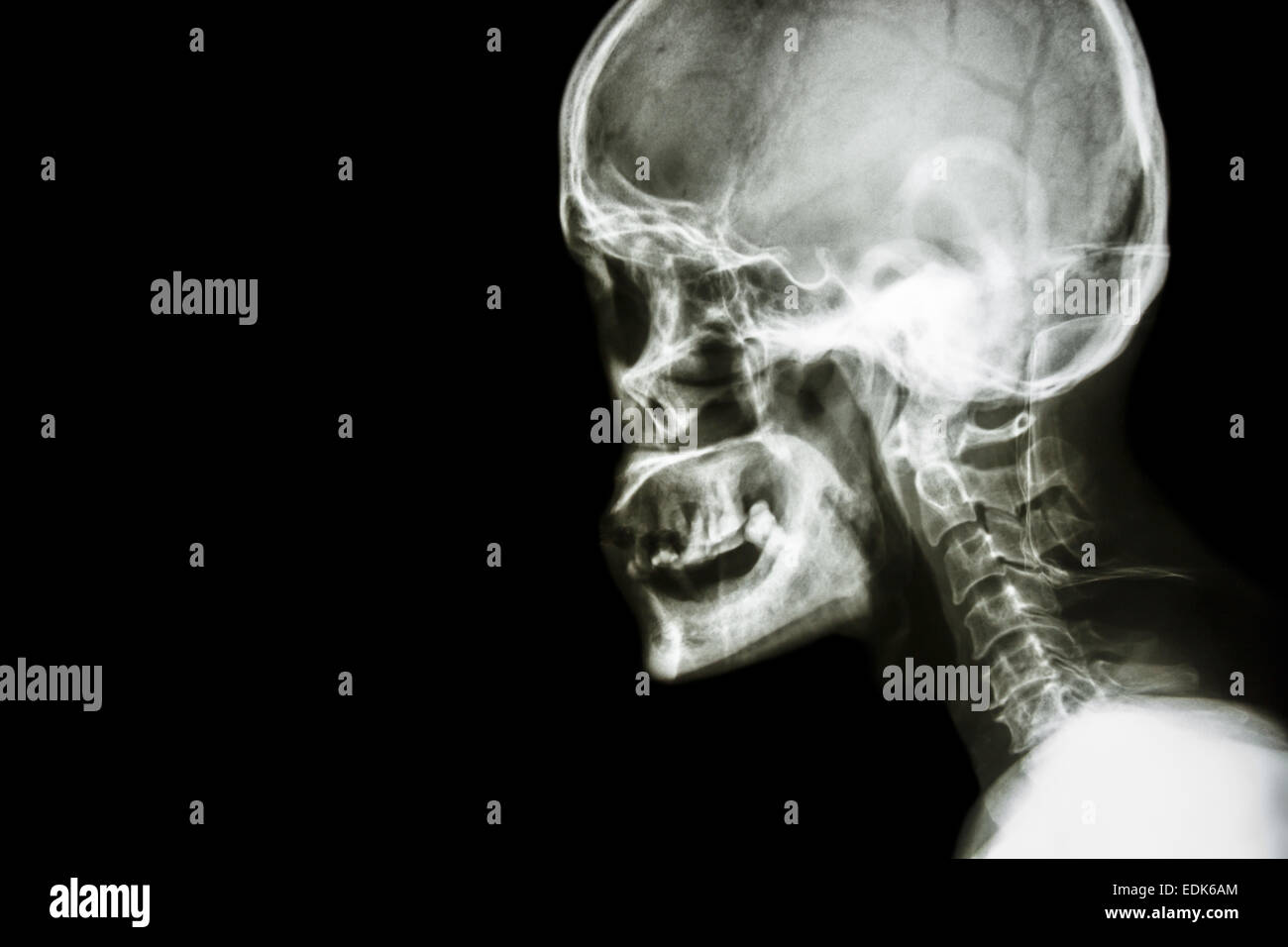 Film x-ray laterale del cranio : mostra umano normale del cranio e della colonna vertebrale cervicale e la zona vuota a sinistra Foto Stock
