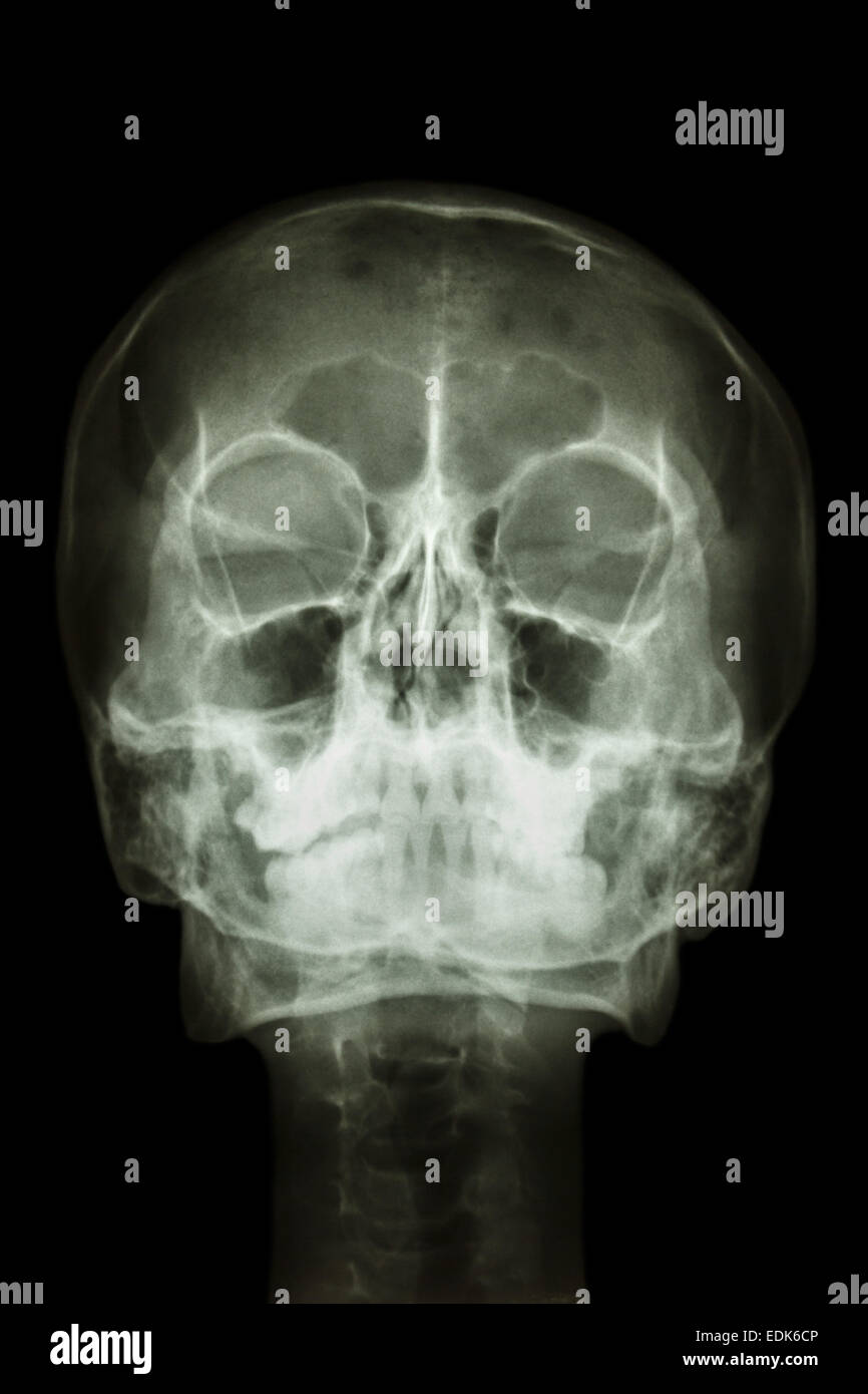 Film x-ray cranio : mostra umano normale del cranio e della colonna cervicale Foto Stock