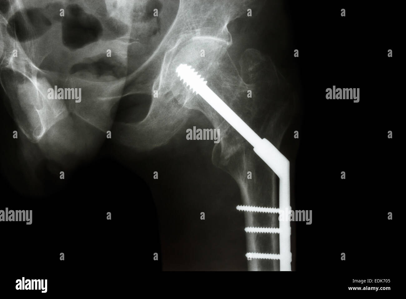 Film x-ray anca sinistra : mostra la frattura del collo del femore(coscia di osso). paziente è stata azionata e osso fisso a vite Foto Stock