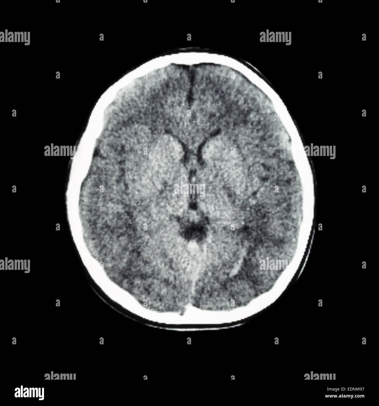 La normale scansione TC del cervello (tomografia computerizzata) Foto Stock