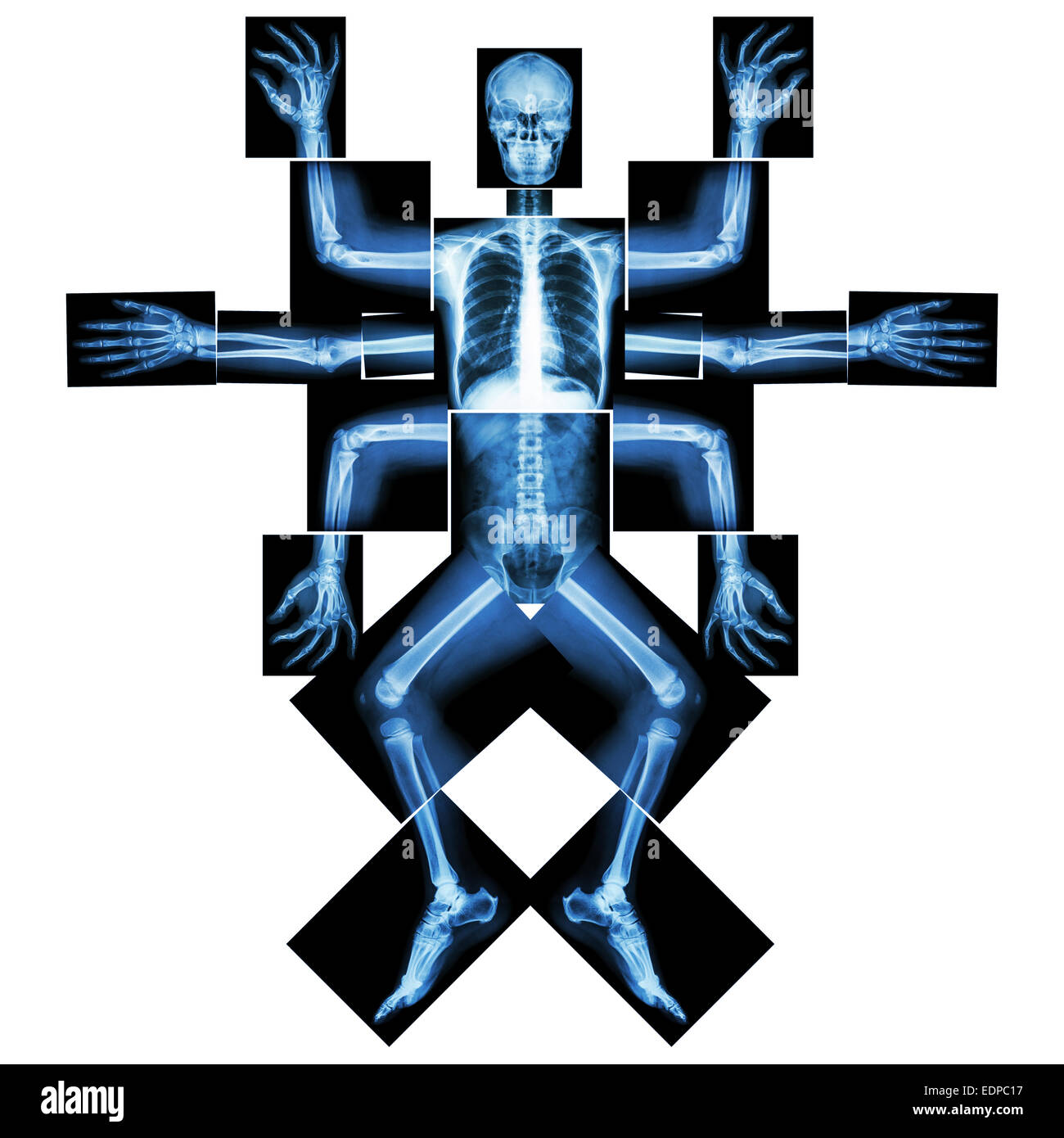 Monster ha molti braccio. (X-ray tutto il corpo : collo capo spalla dell'avambraccio del braccio a gomito mano polso cifre nervatura torace cuore polmonare dorso abd Foto Stock