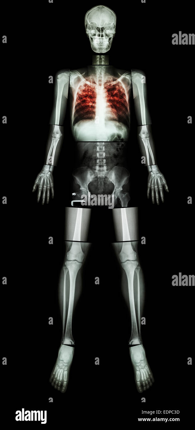 La tubercolosi polmonare(TB)(X-ray tutto il corpo : testa collo cranio colonna vertebrale spalla gomito del braccio avambraccio polso mano dito torace torace egli Foto Stock