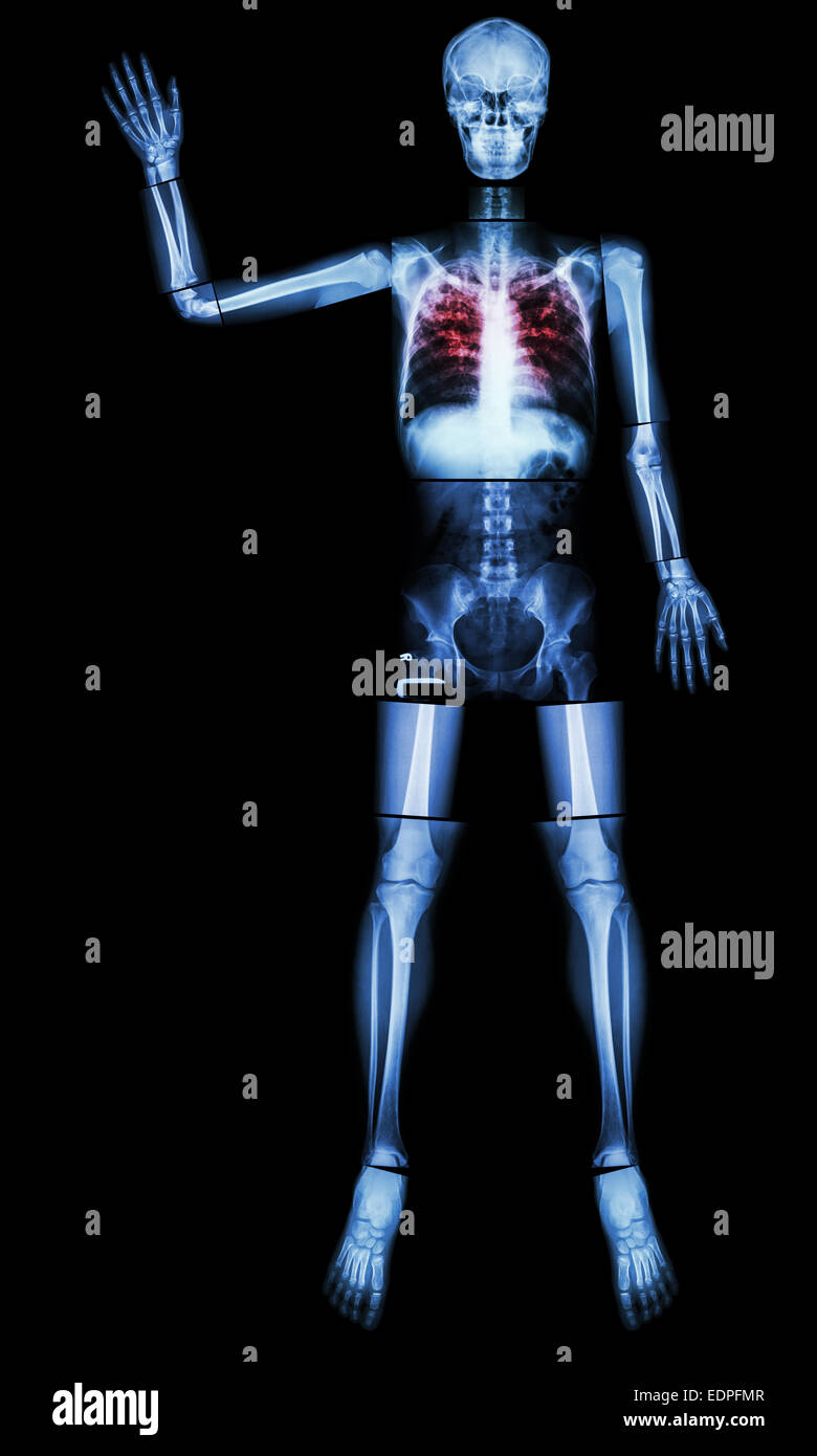 Stop TB(La tubercolosi) (osso umano di alzare la mano) (corpo intero :testa collo cranio colonna vertebrale spalla gomito del braccio avambraccio polso mano dito t Foto Stock