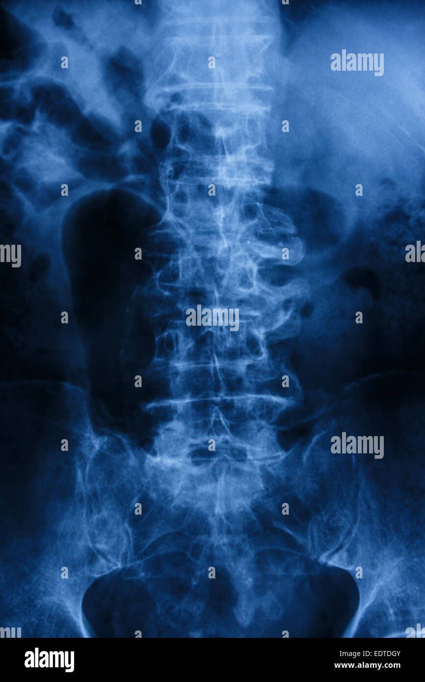 'Spondylosis' Film x-ray : Colonna lombare con sperone & crolli al corpo della spina dorsale Foto Stock